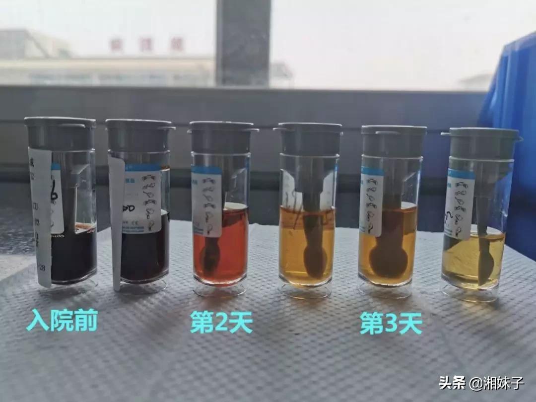 3岁宝宝高烧不退不尿,一周岁孩子高烧完尿是粉红色的