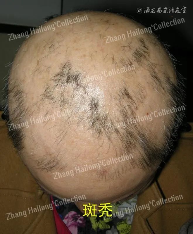 托法替尼治疗斑秃,斑蝥治疗斑秃配方