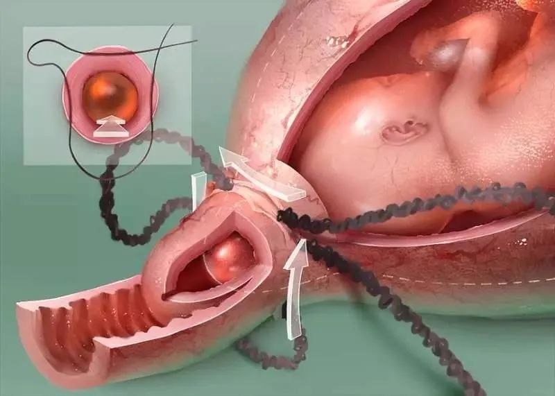 宫颈环扎后要卧床多久,环扎手术后要卧床到几周