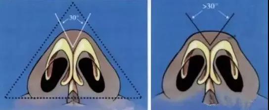 鼻头大鼻翼宽怎么改鼻痕,整鼻不好看怎么办