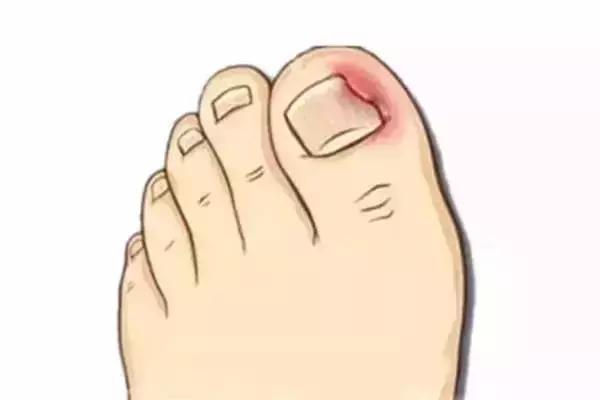 脚趾甲长进肉里剪不出来疼,彻底治愈脚趾甲往肉里长的方法