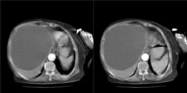 发现肝脏结节要做哪些检查,发现肝部有小结节用治疗吗