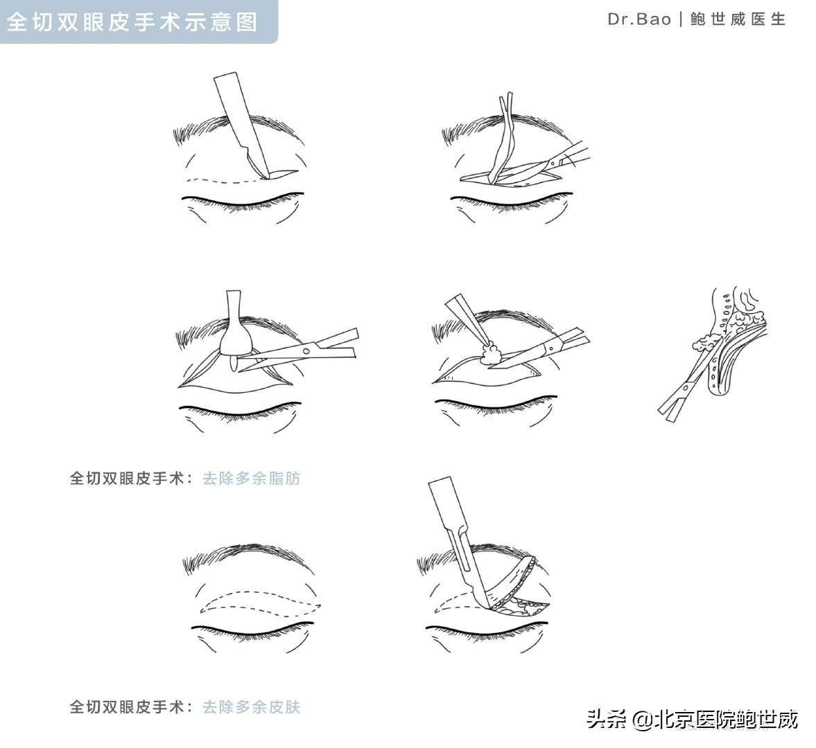 肿眼泡不解决会怎么办,肿眼泡睁不开怎么办