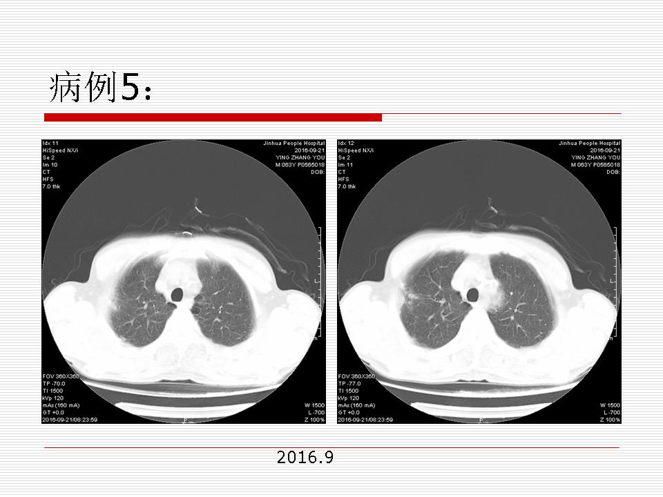 像炎症的肺癌能治好吗,医生说可能是肺癌也可能是炎症