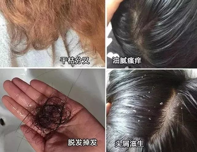 有头皮屑头痒用什么药治,头皮屑多头痒用啥洗发水