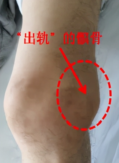 不同部位膝关节,骨科医生教你一招搞定膝盖痛