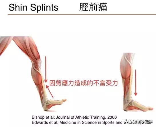 伤害了1/3跑者的胫骨炎,请务必重视起来