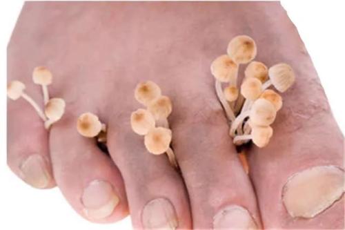 一到夏季脚气犯了怎么办,香港脚教你一招解决脚气