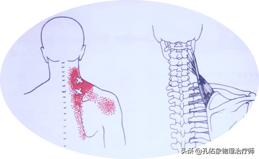 后背肩胛骨疼什么原因造成的,深呼吸造成右后背肩胛骨下方疼痛