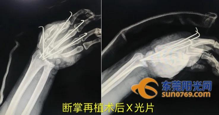 痛！一饭堂厨师砍猪脚时竟砍断了自己的手