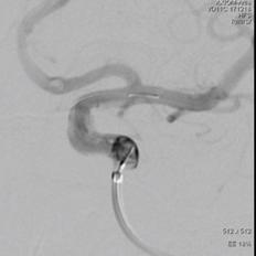 颈内动脉c3段动脉瘤是什么症状,右颈内动脉c3段动脉瘤是什么意思