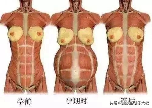 产后腹直肌分离什么症状,产后腹直肌分离如何自测