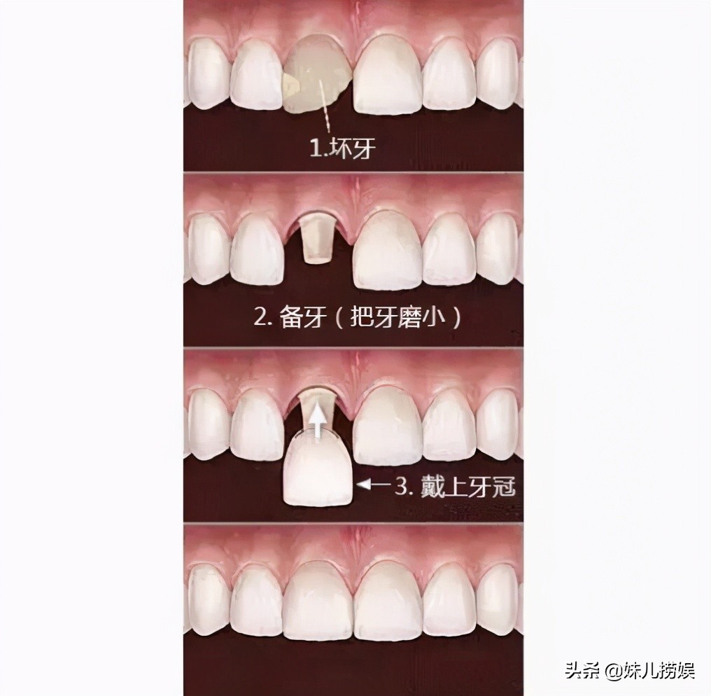 烤瓷牙美白注意事项,烤瓷牙选错颜色有点黄如何美白