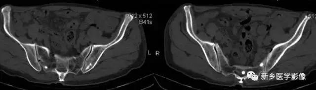 腹部平片可以看出肠胃疾病吗,腹部散在结节状高密度影