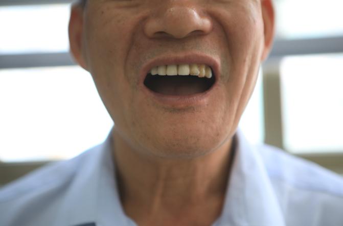 老年人半口缺牙有几种修复方法,老年人大部分缺牙的最佳治疗方法