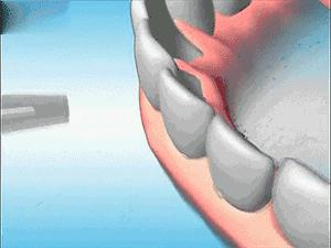 牙龈有血腥气怎么回事,嘴里有血腥味牙龈出血怎么办