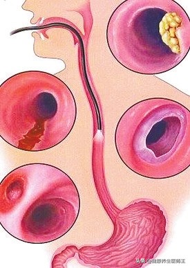 食管癌四期化疗能延长多久生命,食管癌手术后健康宣教