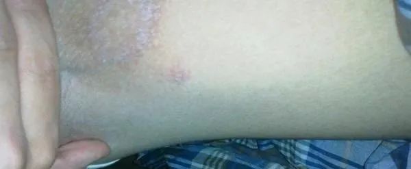 家里治脚气最好的方法,家庭治脚气的最好方法