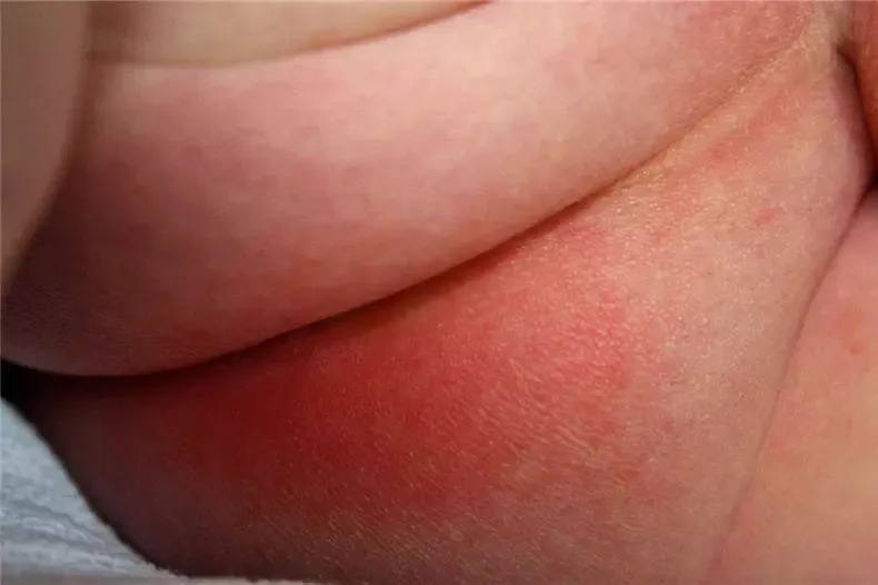 宝宝红屁股的救星,宝宝红屁股了怎么办