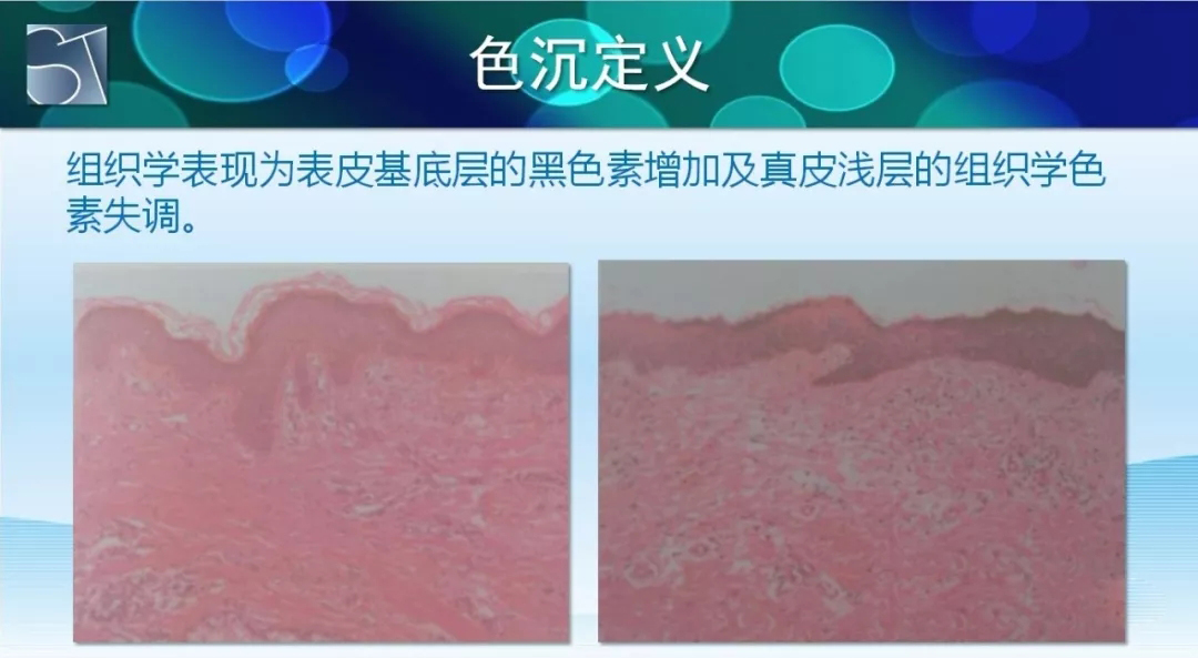 opt祛斑多久能排出色沉,液氮祛斑后色沉严重