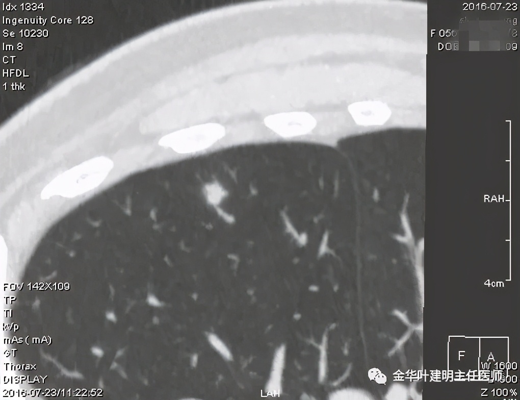 叶建明谈肺结节:一招分辨隐球菌性肉芽肿与肺癌
