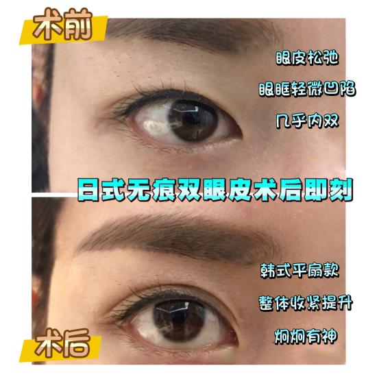 上海九院整形科孙教授,上海九院孙英双眼皮修复