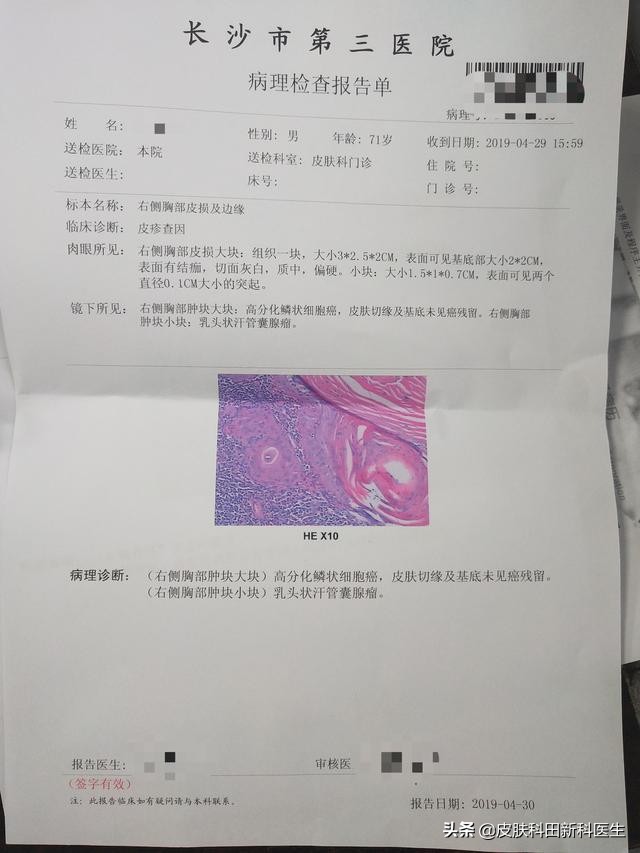 皮肤上长了个瘤子不痛不痒,皮肤上有肿物是什么原因