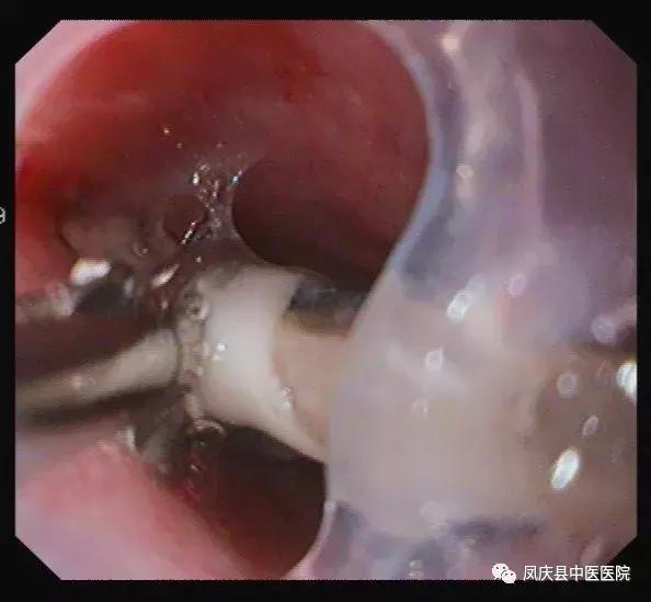 凤庆中医：谨慎“吃鸡”，食管异物取出化危急