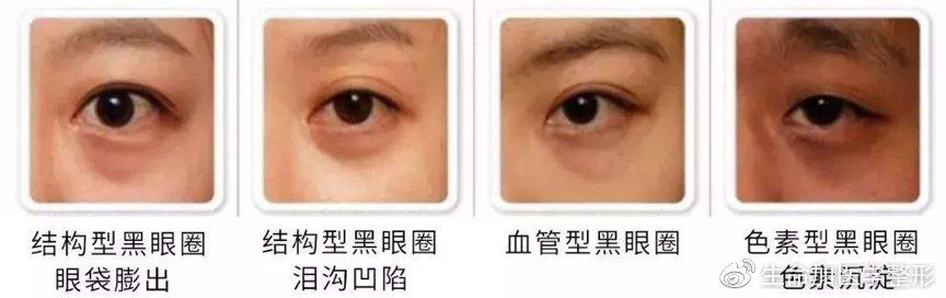 去除黑眼圈最有效的方法,男士激光去除黑眼圈视频