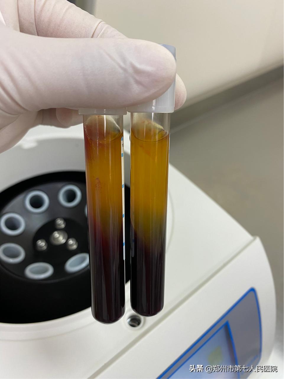 看牙也抽血?什么是CGF?