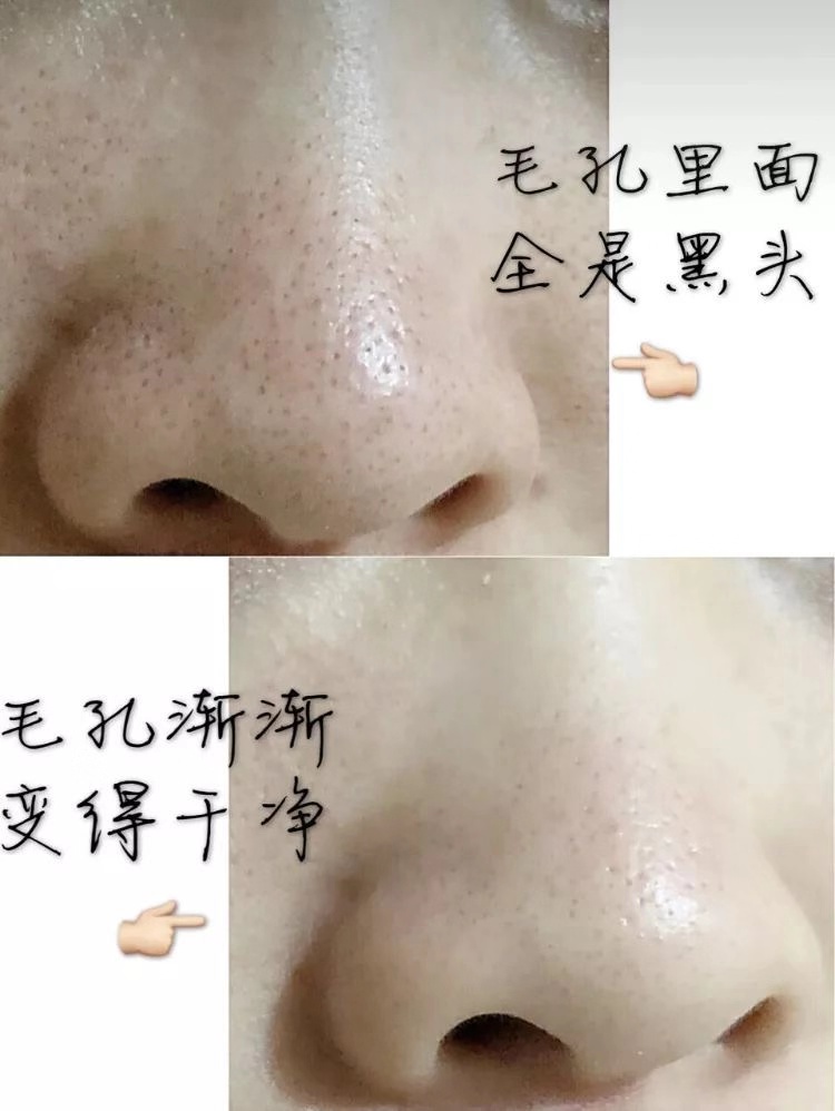 一秒去黑头去粉刺,一步就能搞定的黑头