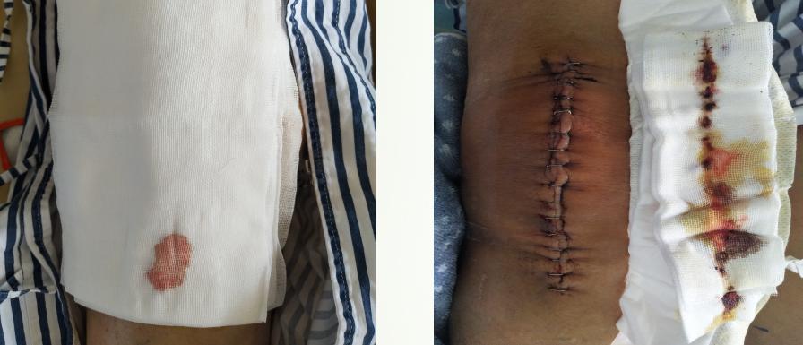 术后不宜大补喝什么,骨伤喝什么汤恢复得快