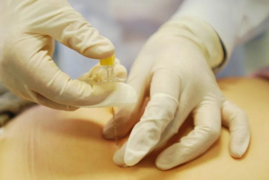 成都中医附院埋线减肥价格表,中医埋线减肥一次需要多少费用