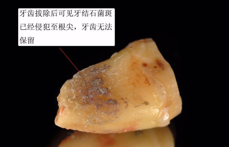 牙齿掉碎块的原因,牙齿掉渣是怎么回事