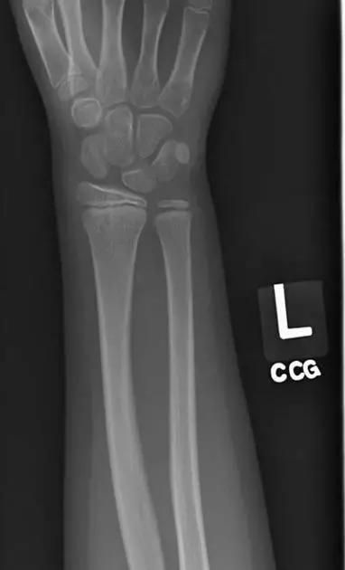 几种严重骨折医学名称,常见的骨折有哪些名称