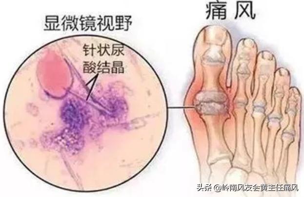 专家谈痛风用药技巧,医生科普痛风如何防治