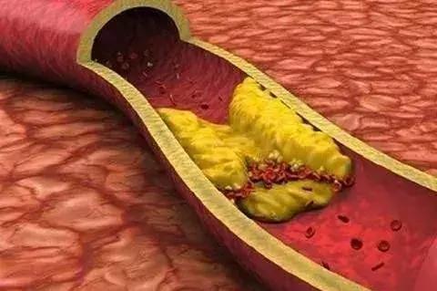 血脂粘稠了,血脂粘稠能调理到正常吗