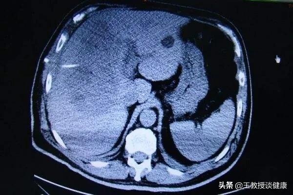 脓肿为什么会有硬结,肝脓肿和糖尿病的关系