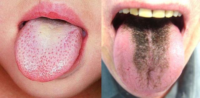 怎样正确刷牙去除口臭,怎么刷牙才能正确去除口臭