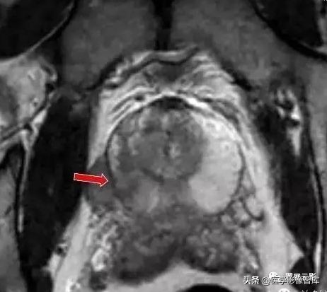 18种泌尿生殖系统常见疾病MR诊断总结