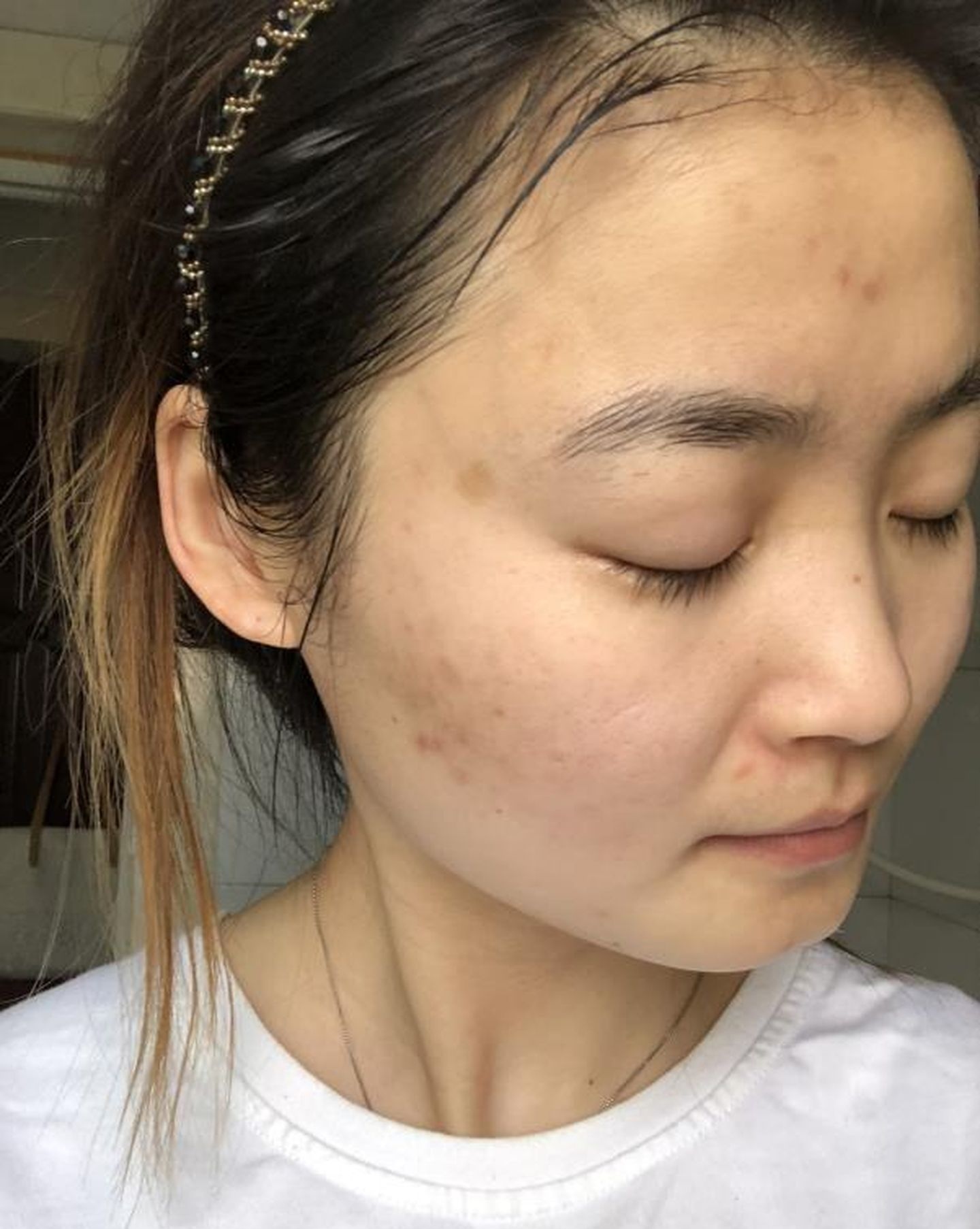 维生素b6祛痘推荐,马齿苋祛痘精华液