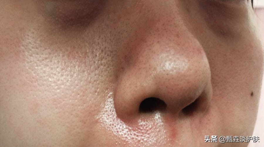 5款高人气“黑头导出液”深度分析报告