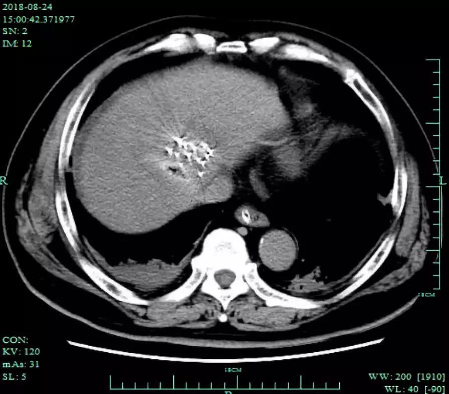 肝癌粒子植入和消融哪个好,肿瘤微波消融
