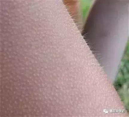 护肤去鸡皮的方法,去鸡皮粗糙皮肤推荐