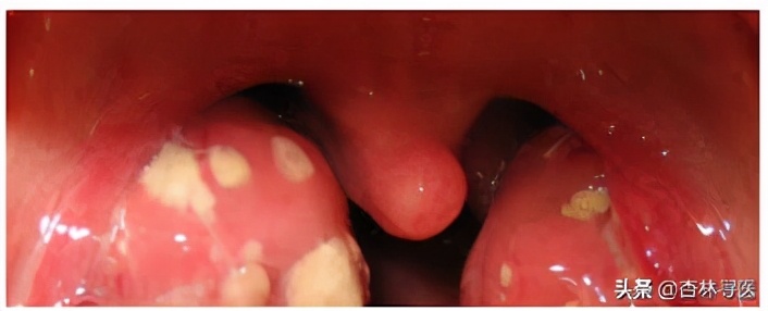 为什么让你家小孩远离嗓子发炎化脓的孩子？咽喉痛要吃抗生素吗？