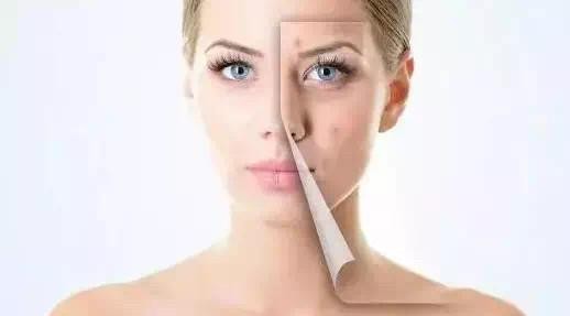 被黑头粉刺挤出来的痘痘怎么办,被粉刺闭口困扰怎么办