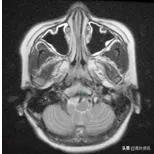 放疗不独用于癌症，治疗良性病也有奇效