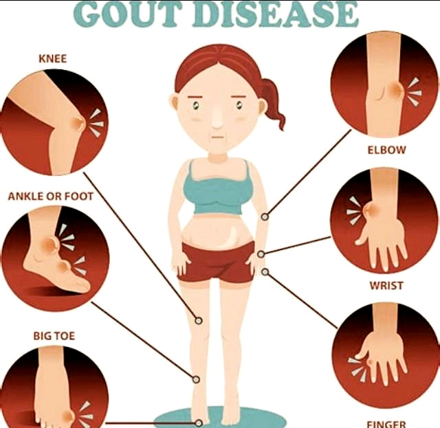 治痛风降尿酸记住这10点,运动排汗痛风