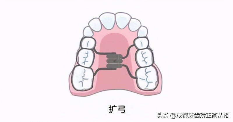 儿童牙齿拥挤矫正,牙齿拥挤矫正过程