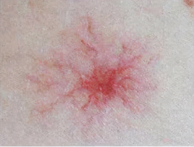 肝病身上出现小红点是怎么回事,肝病患者身上出现小红点意味什么